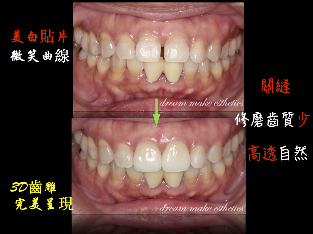 美白貼片
